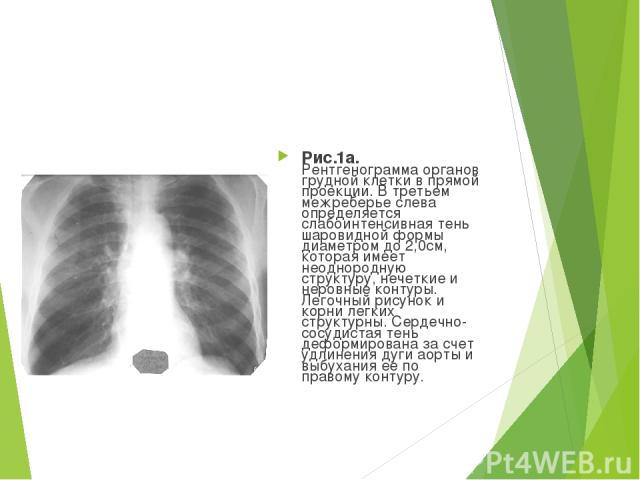 Рис.1а. Рентгенограмма органов грудной клетки в прямой проекции. В третьем межреберье слева определяется слабоинтенсивная тень шаровидной формы диаметром до 2,0см, которая имеет неоднородную структуру, нечеткие и неровные контуры. Легочный рисунок и…