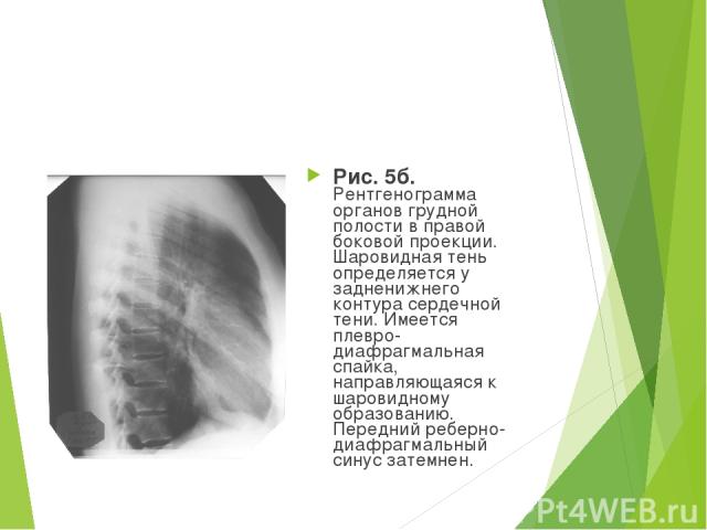 Рис. 5б. Рентгенограмма органов грудной полости в правой боковой проекции. Шаровидная тень определяется у задненижнего контура сердечной тени. Имеется плевро-диафрагмальная спайка, направляющаяся к шаровидному образованию. Передний реберно-диафрагма…