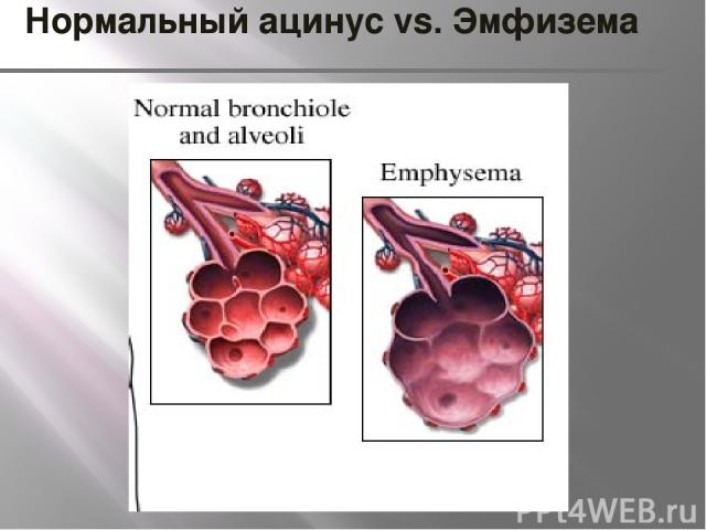 Нормальный ацинус vs. Эмфизема