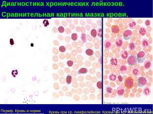 Диагностика хронических лейкозов. Сравнительная картина мазка крови. Периф. Кров