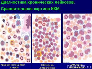 ККМ при хр. лимфолейкозе Красный костный мозг в норме ККМ при хр. миелолейкозе Д