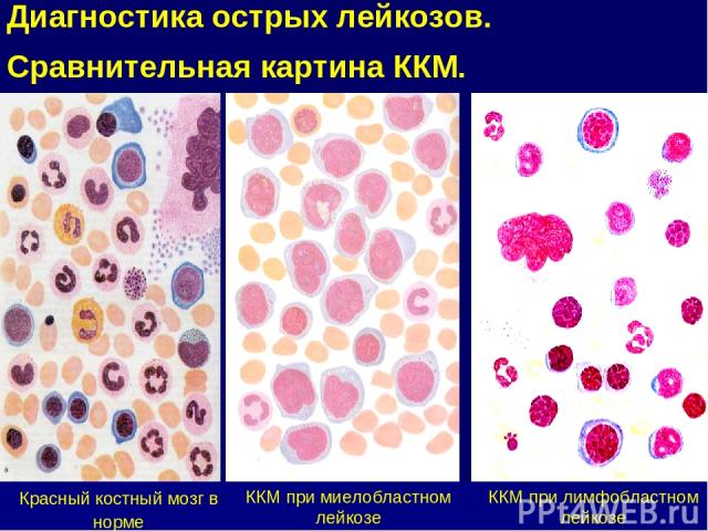 Красный костный мозг в норме ККМ при лимфобластном лейкозе ККМ при миелобластном лейкозе Диагностика острых лейкозов. Сравнительная картина ККМ.