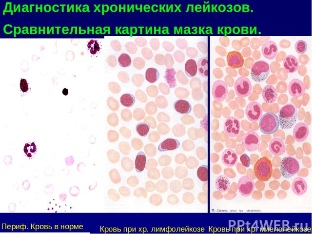 Диагностика хронических лейкозов. Сравнительная картина мазка крови. Периф. Кровь в норме Кровь при хр. лимфолейкозе Кровь при хр. миелолейкозе