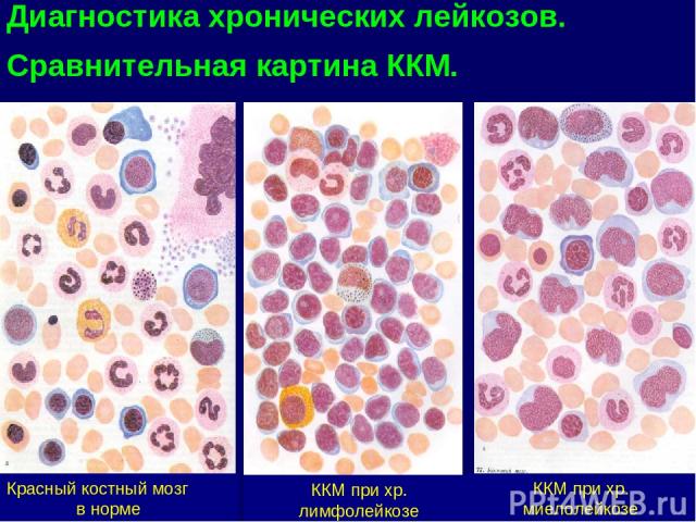 ККМ при хр. лимфолейкозе Красный костный мозг в норме ККМ при хр. миелолейкозе Диагностика хронических лейкозов. Сравнительная картина ККМ.