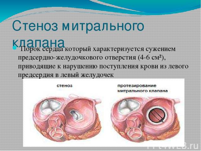 Стеноз митрального клапана  Порок сердца который характеризуется сужением предсердно-желудочкового отверстия (4-6 см²), приводящие к нарушению поступления крови из левого предсердия в левый желудочек