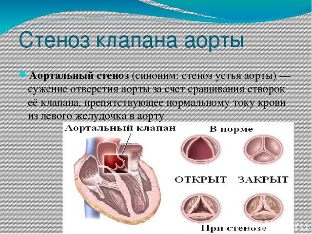 Стеноз клапана аорты Аортальный стеноз (синоним: стеноз устья аорты) — сужение отверстия аорты за счет сращивания створок её клапана, препятствующее нормальному току крови из левого желудочка в аорту
