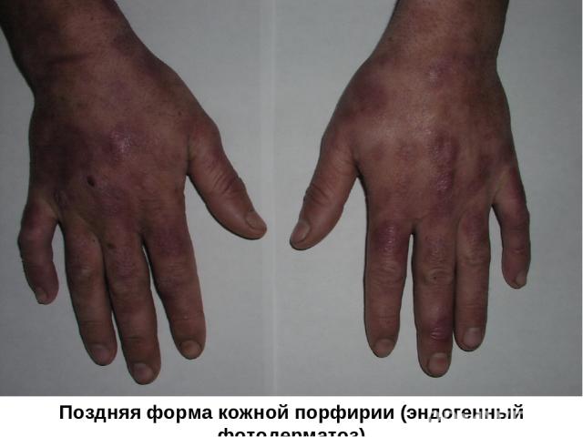 Поздняя форма кожной порфирии (эндогенный фотодерматоз)
