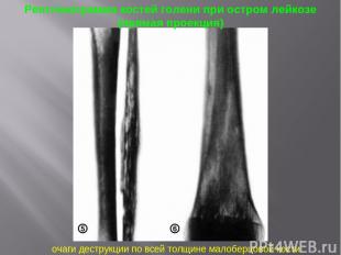 Рентгенограмма костей голени при остром лейкозе (прямая проекция) очаги деструкц