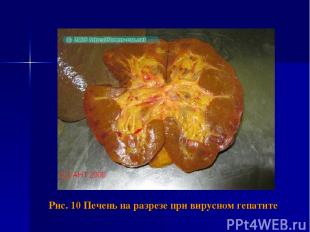 Рис. 10 Печень на разрезе при вирусном гепатите