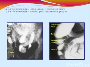 А. Рентгенисследование: болезнь Крона, стеноз тонкой кишки б. Рентгенисследовани