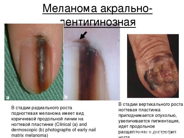 Меланома акрально-лентигинозная В стадии радиального роста подногтевая меланома имеет вид коричневой продольной линии на ногтевой пластинке (Clinical (a) and dermoscopic (b) photographs of early nail matrix melanoma) В стадии вертикального роста ног…
