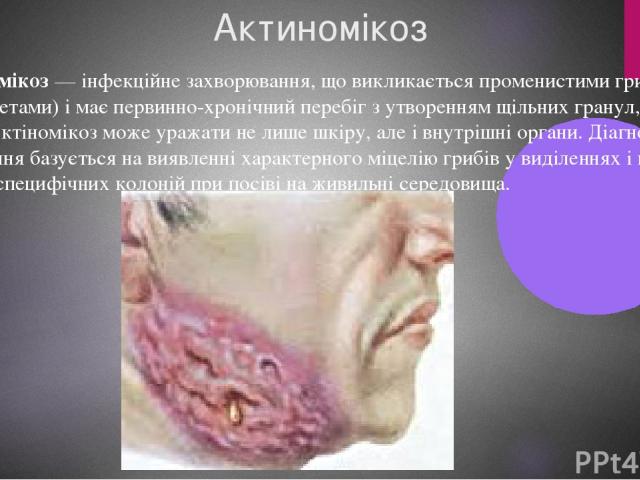 Актиномікоз Актіномікоз — інфекційне захворювання, що викликається променистими грибами (актиноміцетами) і має первинно-хронічний перебіг з утворенням щільних гранул, свищів і абсцесів. Актіномікоз може уражати не лише шкіру, але і внутрішні органи.…