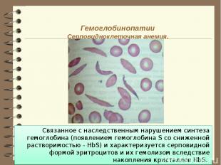 Гемоглобинопатии Серповидноклеточная анемия.