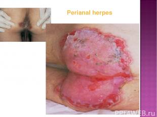 Perianal herpes