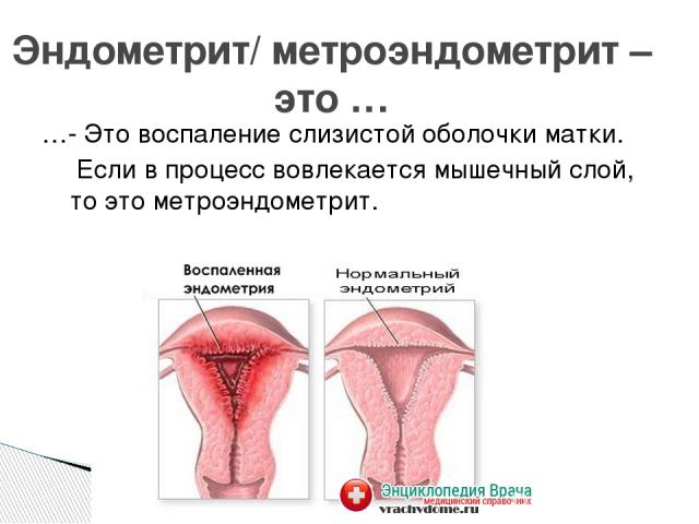 …- Это воспаление слизистой оболочки матки. Если в процесс вовлекается мышечный слой, то это метроэндометрит. Эндометрит/ метроэндометрит – это …