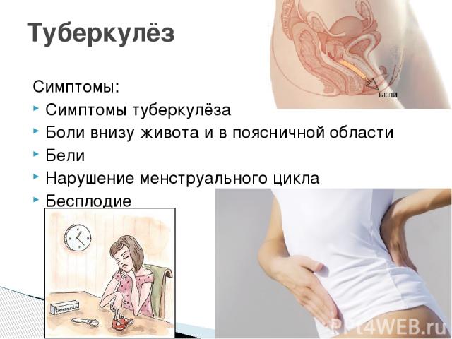 Симптомы: Симптомы туберкулёза Боли внизу живота и в поясничной области Бели Нарушение менструального цикла Бесплодие Туберкулёз