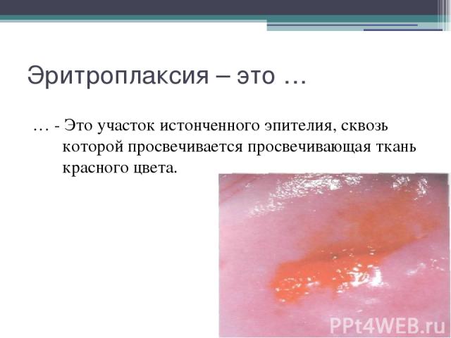 Эритроплаксия – это … … - Это участок истонченного эпителия, сквозь которой просвечивается просвечивающая ткань красного цвета.