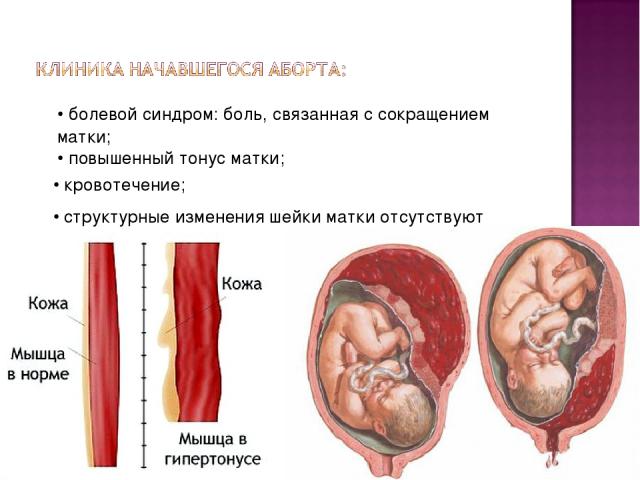 • болевой синдром: боль, связанная с сокращением матки; • повышенный тонус матки; • кровотечение; • структурные изменения шейки матки отсутствуют