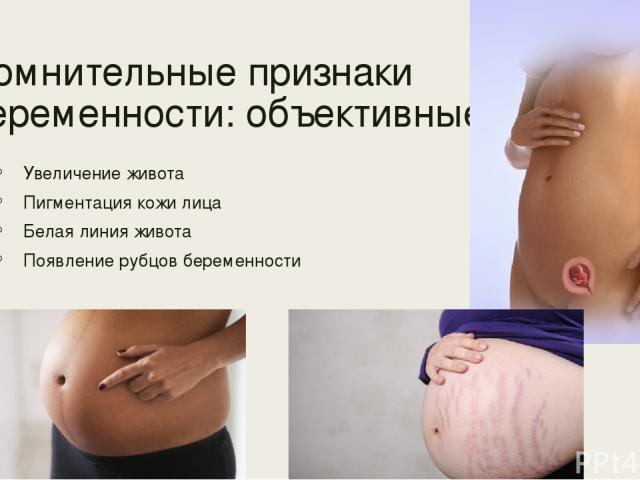 Сомнительные признаки беременности: объективные: Увеличение живота Пигментация кожи лица Белая линия живота Появление рубцов беременности