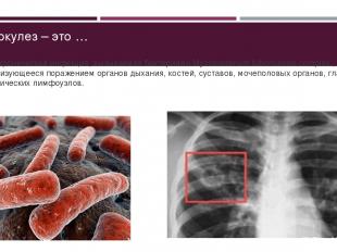 Туберкулез – это … ... – Это хроническая инфекция, вызываемая бактериями Mycobac