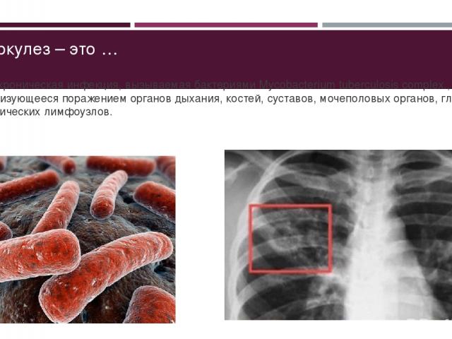 Туберкулез – это … ... – Это хроническая инфекция, вызываемая бактериями Mycobacterium tuberculosis complex., характеризующееся поражением органов дыхания, костей, суставов, мочеполовых органов, глаз, периферических лимфоузлов.