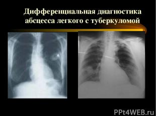Дифференциальная диагностика абсцесса легкого с туберкуломой