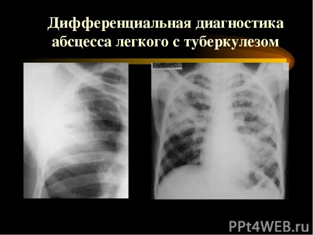 Дифференциальная диагностика абсцесса легкого с туберкулезом