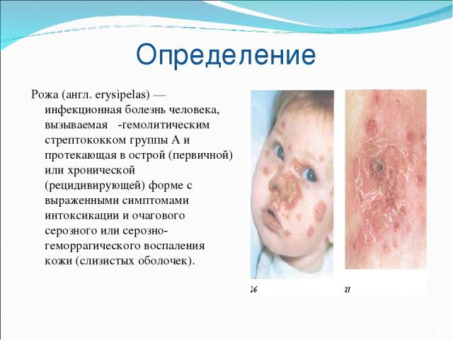 Определение Рожа (англ. еrysipelas) — инфекционная болезнь человека, вызываемая β-гемолитическим стрептококком группы А и протекающая в острой (первичной) или хронической (рецидивирующей) форме с выраженными симптомами интоксикации и очагового сероз…