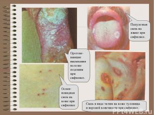 Орогове-вающие высыпания на коже подошвы при сифилисе. Оспен-новидная сыпь на ко