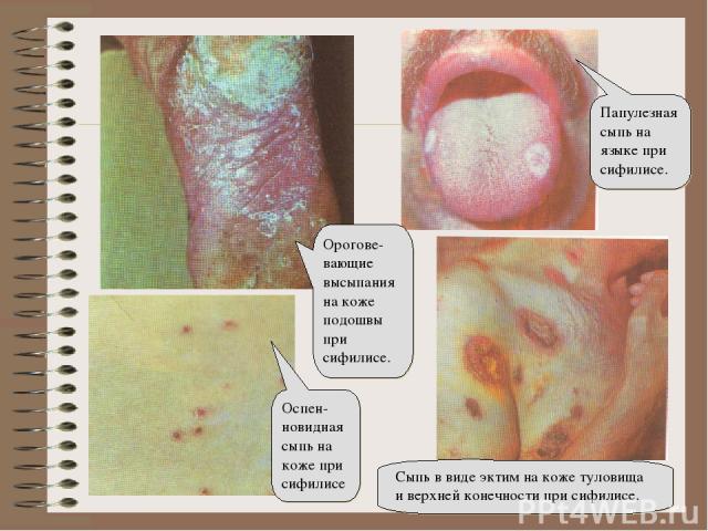 Орогове-вающие высыпания на коже подошвы при сифилисе. Оспен-новидная сыпь на коже при сифилисе Папулезная сыпь на языке при сифилисе. Сыпь в виде эктим на коже туловища и верхней конечности при сифилисе.