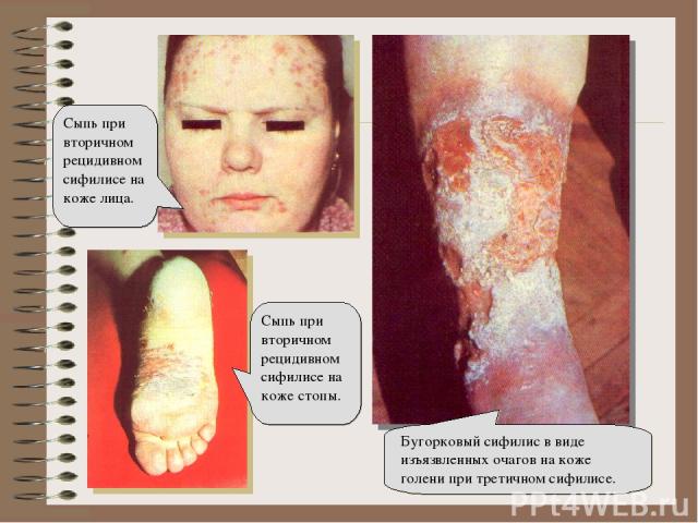 Бугорковый сифилис в виде изъязвленных очагов на коже голени при третичном сифилисе. Сыпь при вторичном рецидивном сифилисе на коже лица. Сыпь при вторичном рецидивном сифилисе на коже стопы.